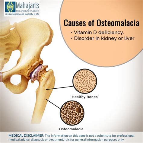 Osteomalacia Bone