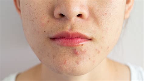 Scientists Still Dont Really Know What Causes Acne Gizmodo Australia