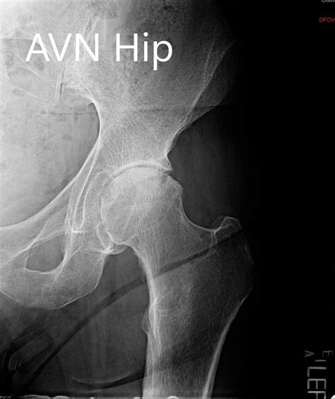 Case Study Robotic Left Hip Total Replacement For Arthritis Secondary