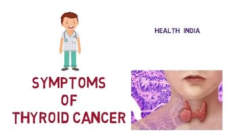 Thyroid cancer ke lakshan. Symptoms of Thyroid Cancer ...