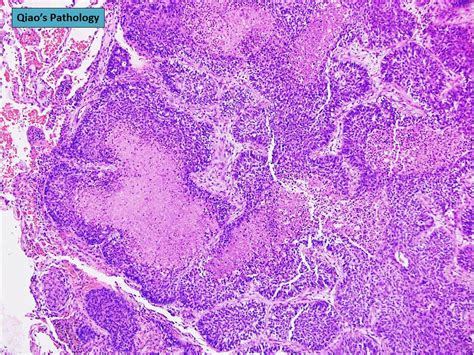 Flickriver Photoset Basaloid Squamous Cell Lung Carcinoma By Qiaos