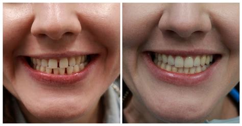 1 doctor answer • 2 doctors weighed in. How Long Does Invisalign Last? - Welcome to Smileville