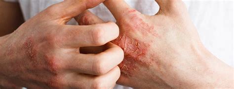 What Is Psoriatic Arthritis And How Do You Treat It Orthopedic