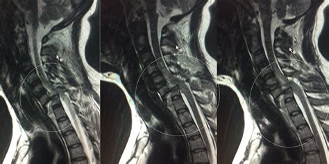 Mri V Cervical Indications Fracture Radiology Imaging