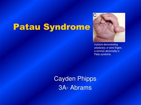 Ppt Patau Syndrome Powerpoint Presentation Free Download Id6905046