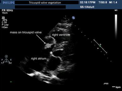 Left Parasternal Window Modified Right Ventricular Inflow And Outflow