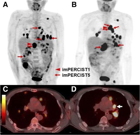 18f Fdg Petct For Monitoring Of Ipilimumab Therapy In Patients With