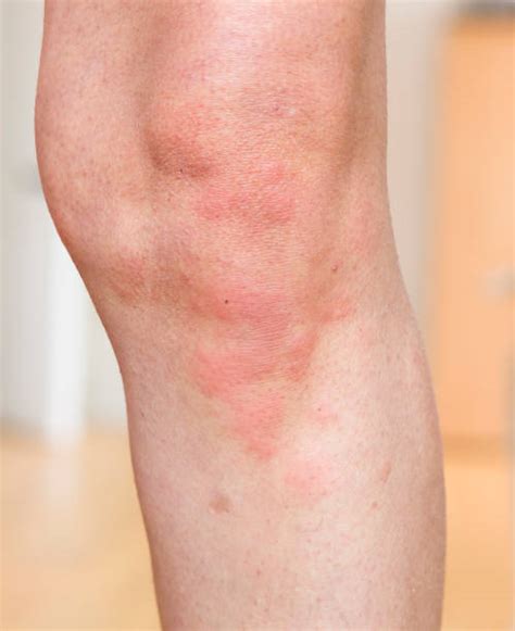 90 Different Skin Rashes Stock Photos Pictures And Royalty Free Images