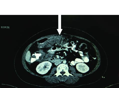 Mesenteric Panniculitis Presenting In A Patient After Laproscopic