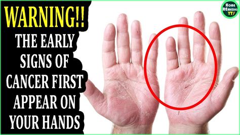 The Early Signs Of Cancer First Appear On Your Hands Symptoms Of