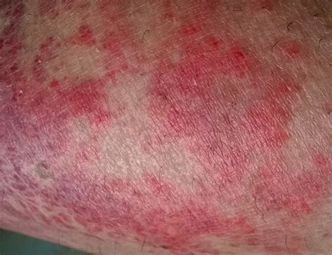 What Is Eczema Irritated Skin Triggers And Treatment Youmemindbody