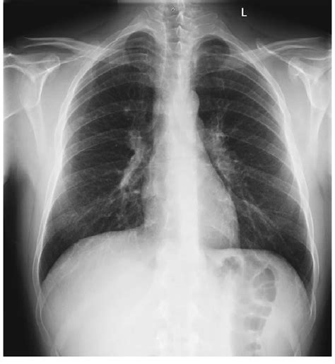 Chest X Ray Showing Bilateral Hilar Prominence Download Scientific