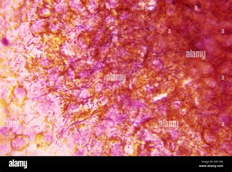 Nocardia Bacteria Hi Res Stock Photography And Images Alamy