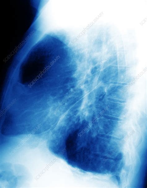 Pleural Asbestosis X Ray Stock Image M1080637 Science Photo Library
