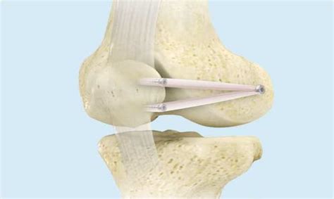 Mpfl Reconstruction Orthopaedic Knee Surgeon Dr David Colvin Perth
