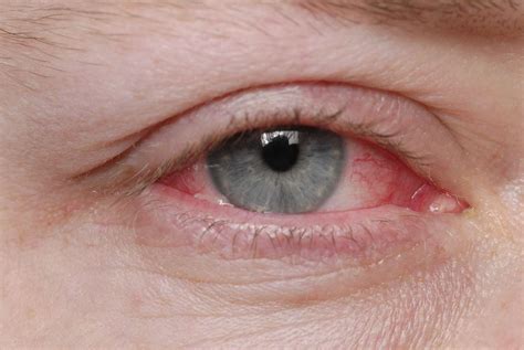 How Long Is Pink Eye Contagious