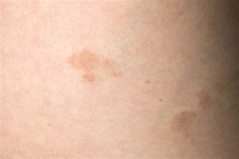 Pityriasis Rosea Three Weeks After The Appearance Of The First Focus On