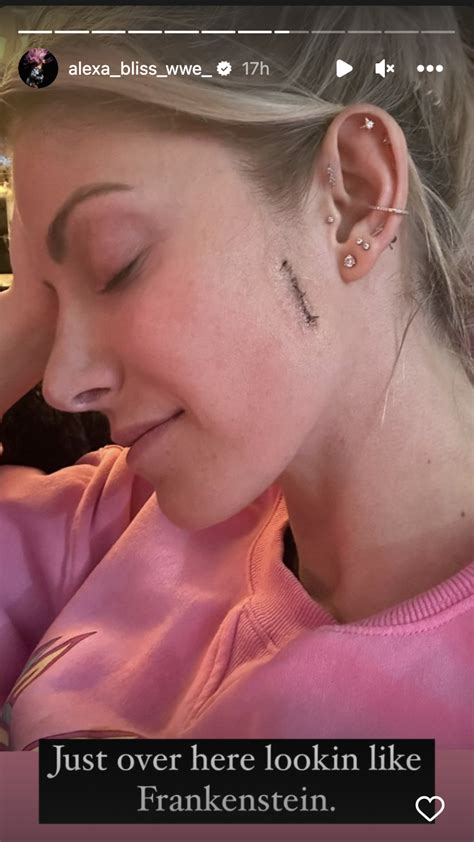 Wwes Alexa Bliss Posts Photo Of Stitches From Skin Cancer Surgery Otbgossip
