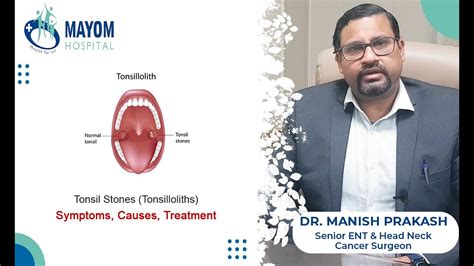 Tonsil Stones Tonsilloliths Causes And Treatment Dr Manish