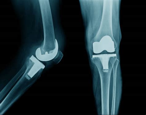 Total Hip Replacement X Ray Pic Stock Photos Pictures And Royalty Free
