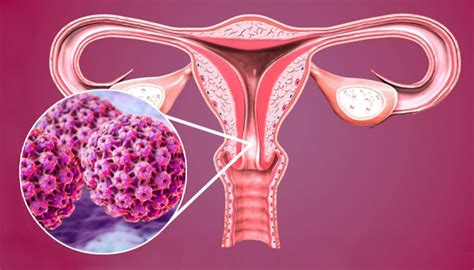 Cancerul de col uterin simptome și prevenție P Români adevărați