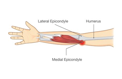 Common Tendon And Soft Tissue Injuries In The Elbow