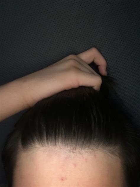 Exegese Folge Planen Laser Hair Removal Widows Peak Geldgummi Peave Incubus