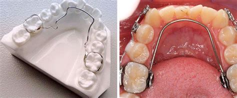 Orthodontics Space Maintainers