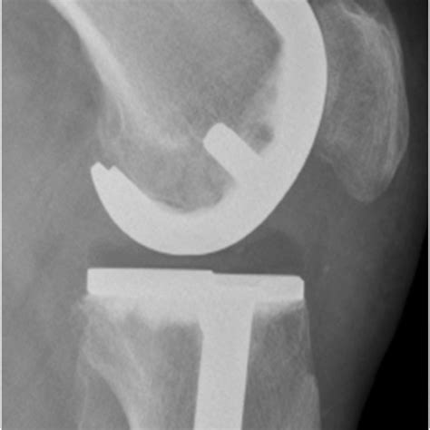 Skyline View Of The Knee Joint Before And After Itotal™ Cr G2