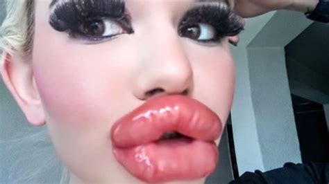 Woman Has Lip Filler Injections To Have Worlds Biggest Lips Photo