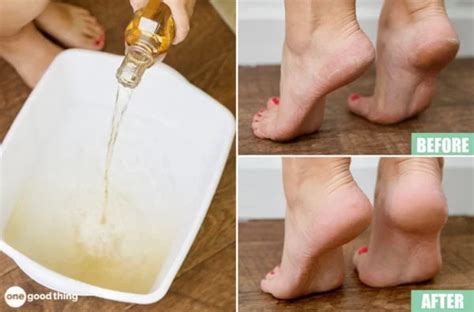 How To Soften Dry Heels With A Listerine And Vinegar Foot Soak · Jillee