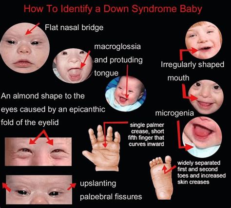 9 Down Syndrome Facts That You Never Knew Just Credible