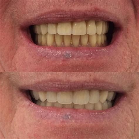 Full Dentures Affordable Denturesㅣpartial Denturesㅣdenture Repairs
