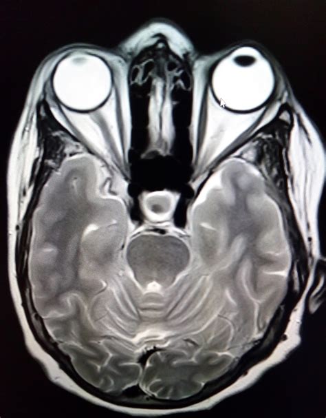 Rathkes Cleft Cyst Mri Sumers Radiology Blog
