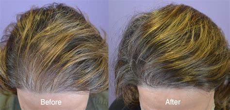 Hair Transplant Before And After Photos Women Hair Restoration Of The South New Orleans La