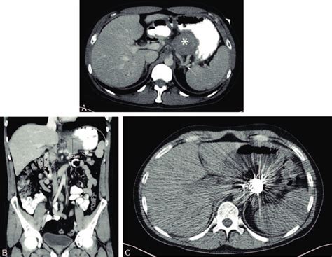 A Axial View Of Abdominal Ct With Iv Contrast Shows A 52 Cm
