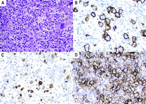 Ebv Positive Diffuse Large B Cell Lymphoma A Core Needle Biopsy Of A