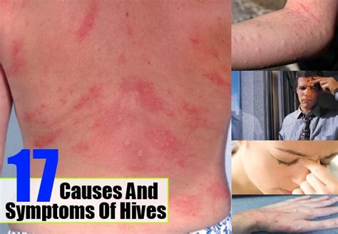 17 Causes And Symptoms Of Hives Hives Causes Plaque Psoriasis