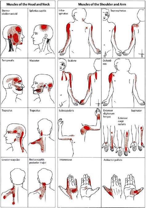 Travell Trigger Point Chart