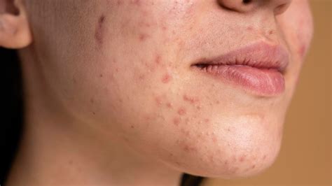 Dark Spots On Face Know What Are The Causes Treatment And More Bulk