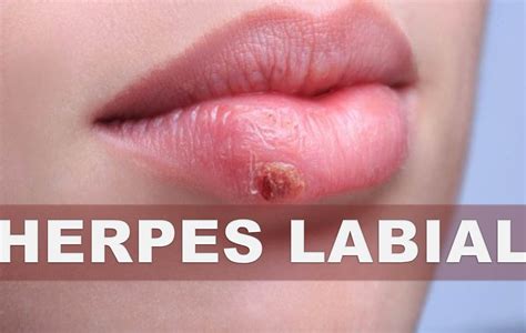 ☞remedios Caseros Para El Herpes Labial Eliminar Las Llagas En Los