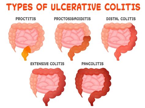 What Is Ulcerative Colitis The Ibs Gut Health Clinic