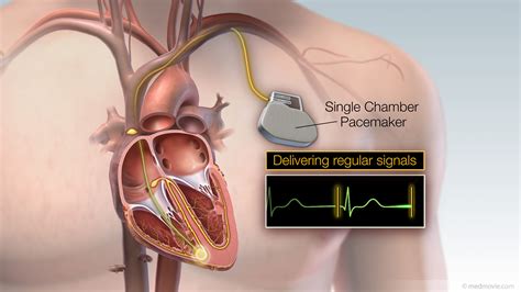 Pacemaker Dual Chamber