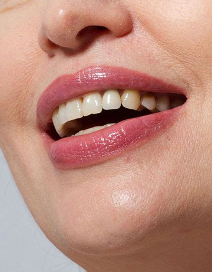Treatment For Discoloured Teeth Face Teeth Smile Gerrards Cross