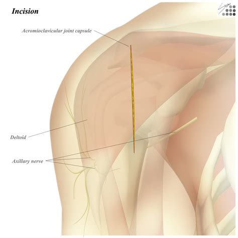 Shoulder Anterolateral Approach Approaches Orthobullets