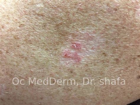 Actinic Keratosis Treatment Oc Medderm Irvine And Orange County