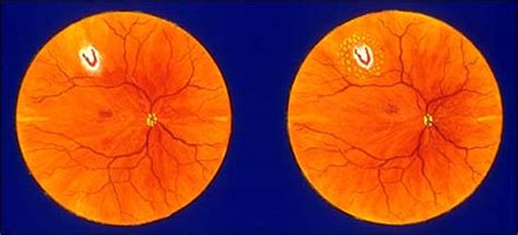 The longer retinal detachment goes untreated, the greater your risk of permanent vision. Conditions: Vitreous Detachment & Floaters | Eugene Eye Care