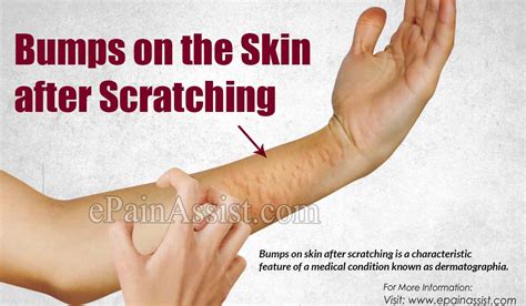 Bumps On The Skin After Scratchingcausessymptomstreatmentprognosis