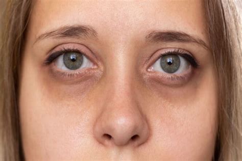 Dark Circles Under The Eyes Causes Treatment And Prevention