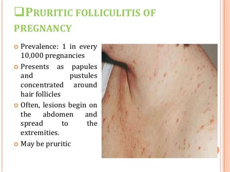 Pruritic Folliculitis Of Pregnancy Pruritic Folliculitis During